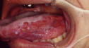 Dấu hiệu bất thường ở lưỡi phải đi khám ngay kẻo ung thư