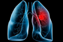 5 dấu hiệu cảnh báo ung thư phổi