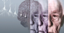 Bệnh về da cảnh báo nguy cơ Alzheimer